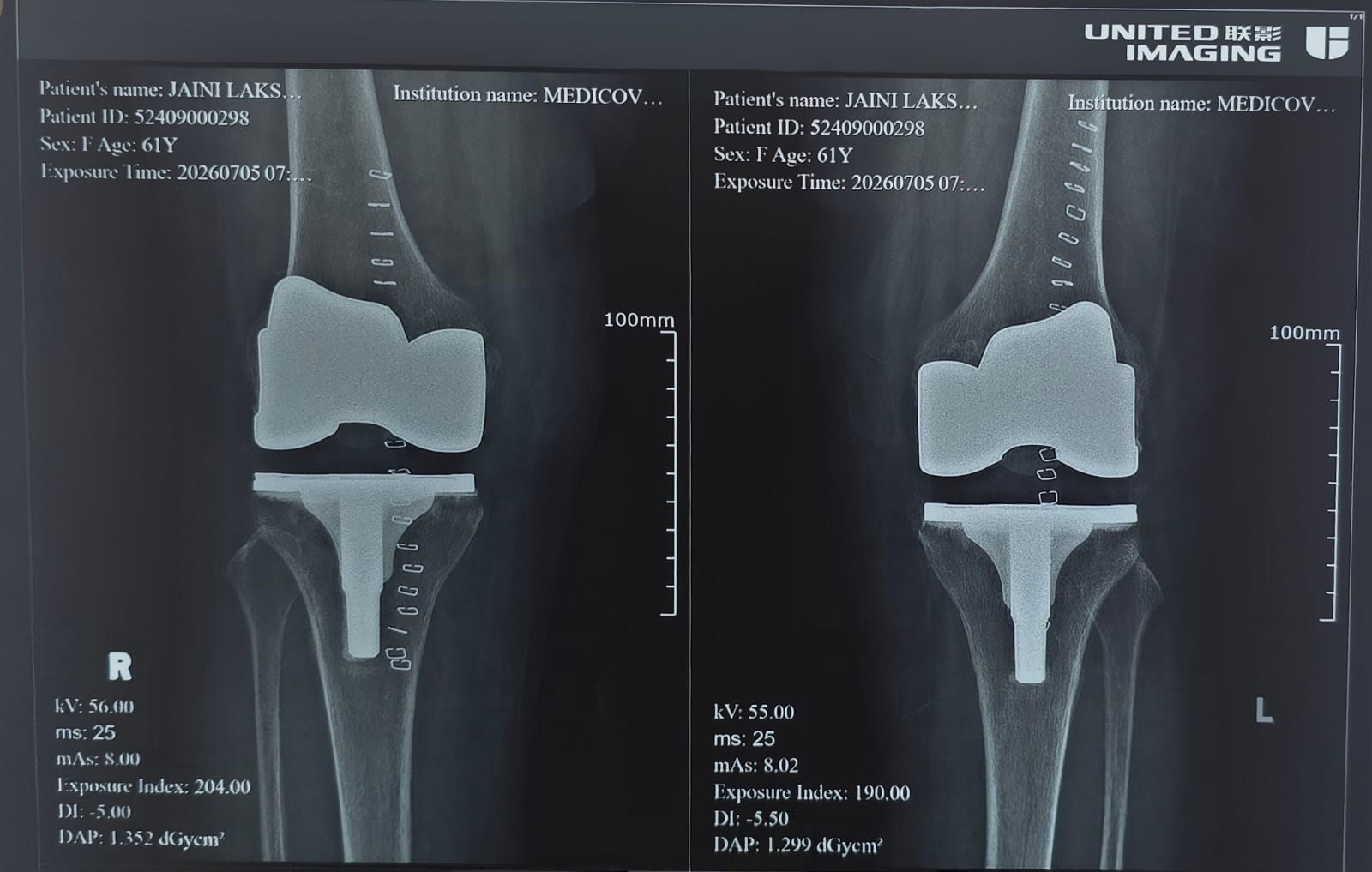 After knee replacement X-ray